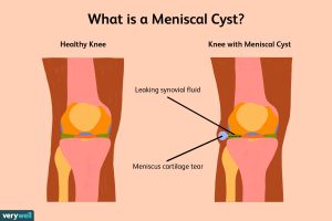 Procedure-to-drag-Meniscal-Cyst