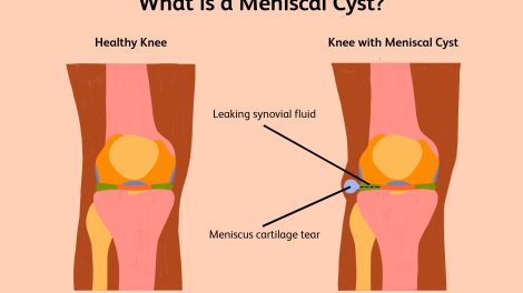 Procedure-to-drag-Meniscal-Cyst