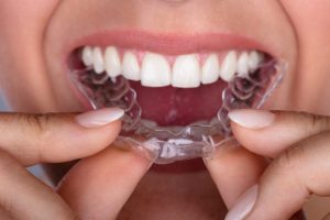 Clear Invisible Braces