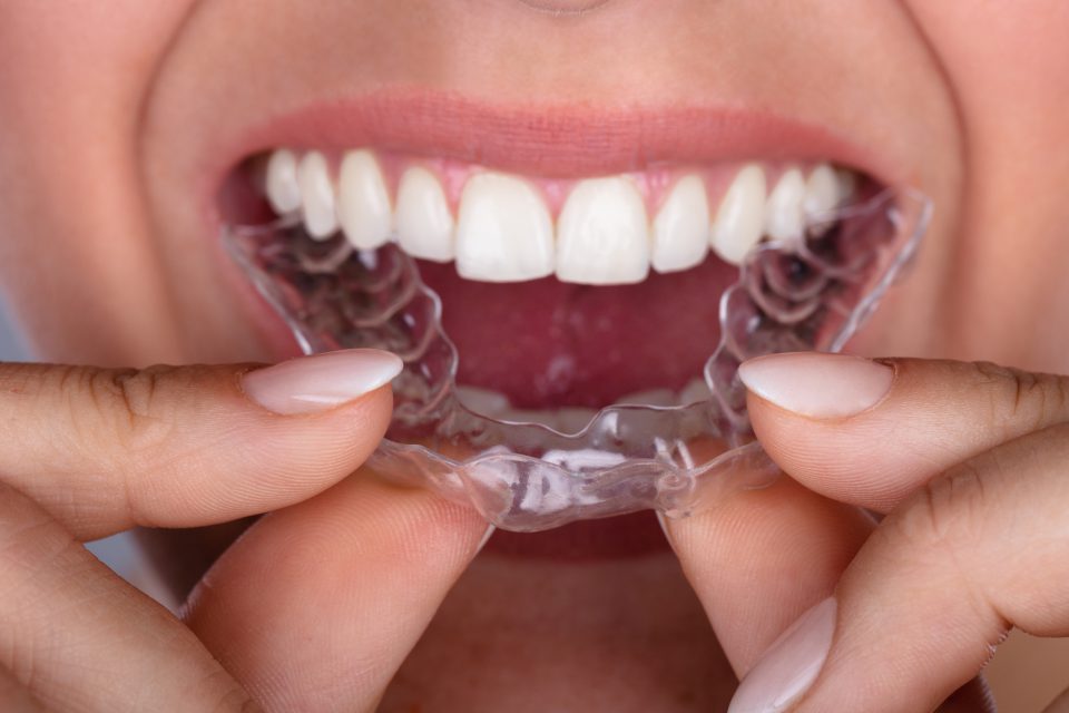Clear Invisible Braces