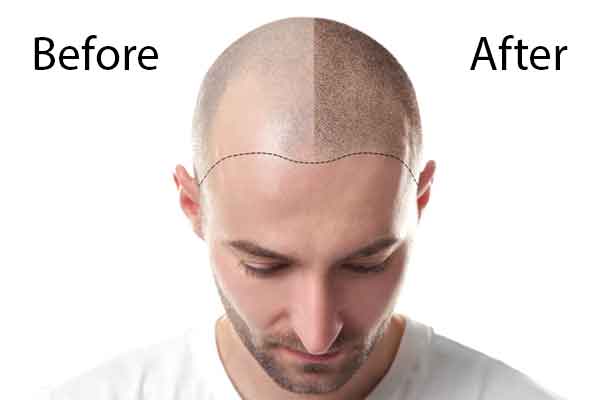 Hair transplant