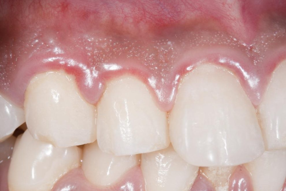 dental abscess symptoms