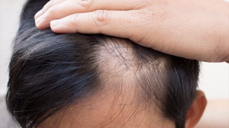 Alopecia areata- Risk Factors Associated With Alopecia and Its Treatment
