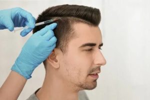 smart fue hair transplant