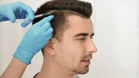 smart fue hair transplant