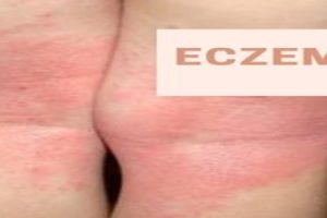 Eczema treatment Singapore