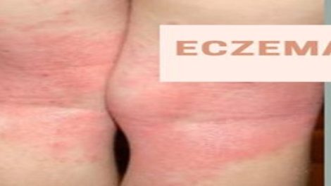 Eczema treatment Singapore