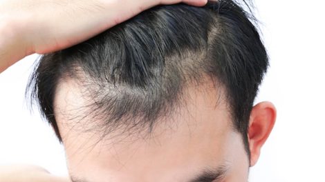 All That You Need To Know About Androgenic Alopecia