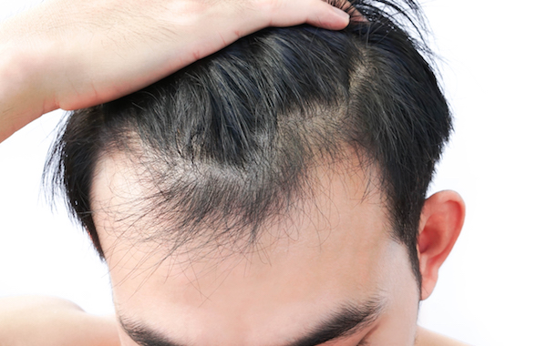 All That You Need To Know About Androgenic Alopecia
