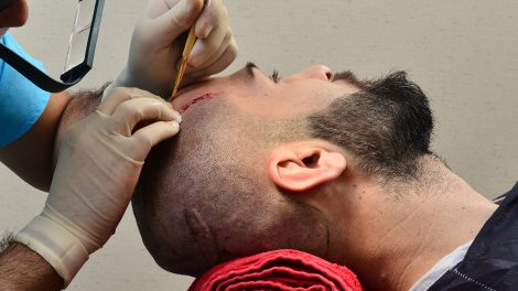 fut hair transplant