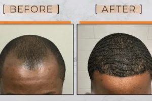 Textured hair transplant -How does Textured Hair Transplant Work? Methods and Benefits