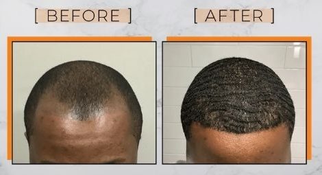 Textured hair transplant -How does Textured Hair Transplant Work? Methods and Benefits