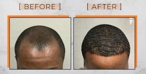 Textured hair transplant -How does Textured Hair Transplant Work? Methods and Benefits