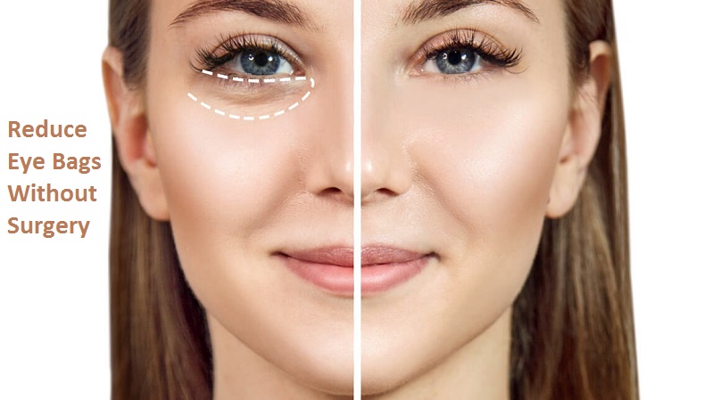 How To Reduce Eye Bags Without Surgery?