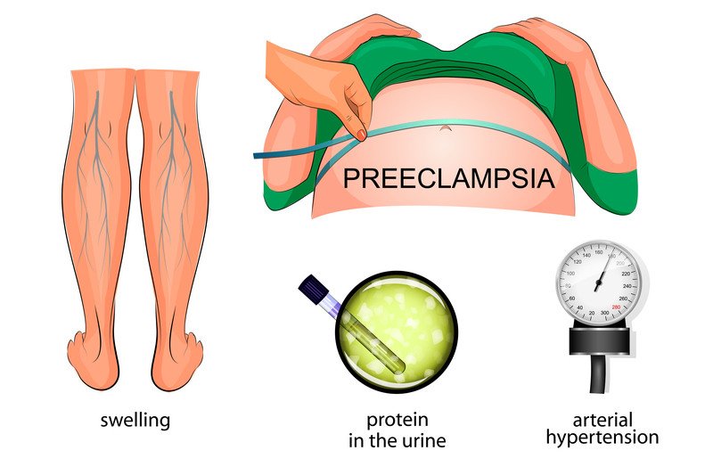 Preeclampsia