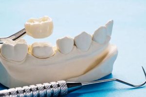 Ceramic Crowns in Dubai Abu Dhabi