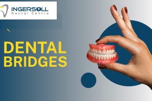 dental bridge