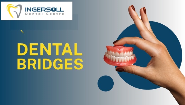 dental bridge