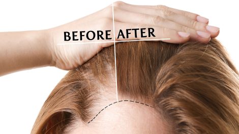 trasplante de cabello en mujeres