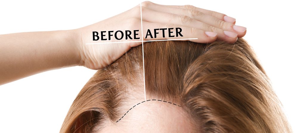 trasplante de cabello en mujeres