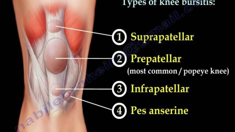 List-some-best-treatments-for-suprapatellar-bursitis