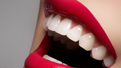 e-max veneers in Dubai