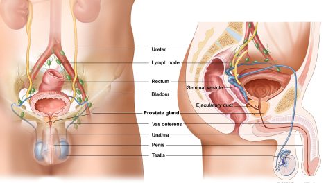 hydrocele