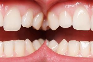 cosmetic dental bonding
