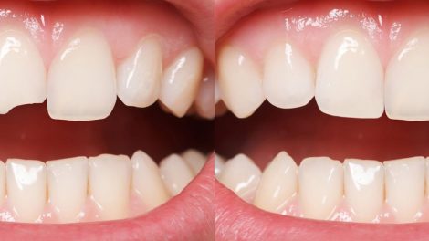 cosmetic dental bonding