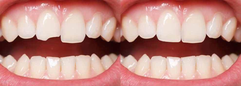 cosmetic dental bonding
