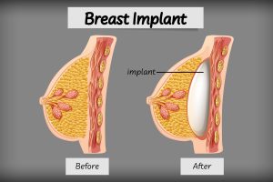 Breast Augmentation