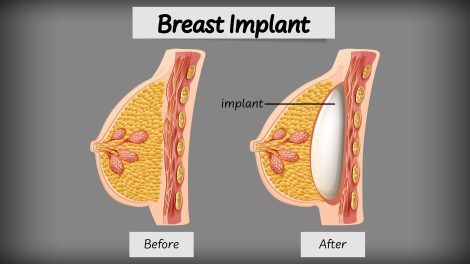 Breast Augmentation
