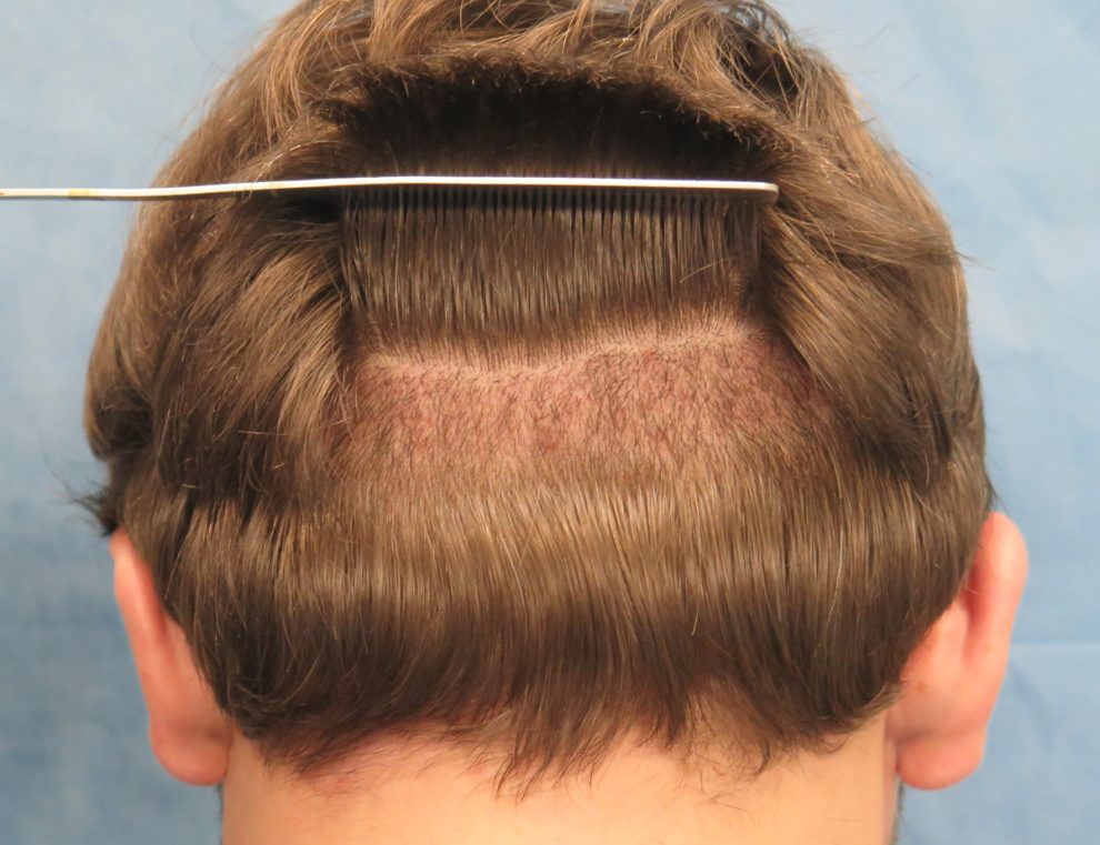 FUE Hair Transplant