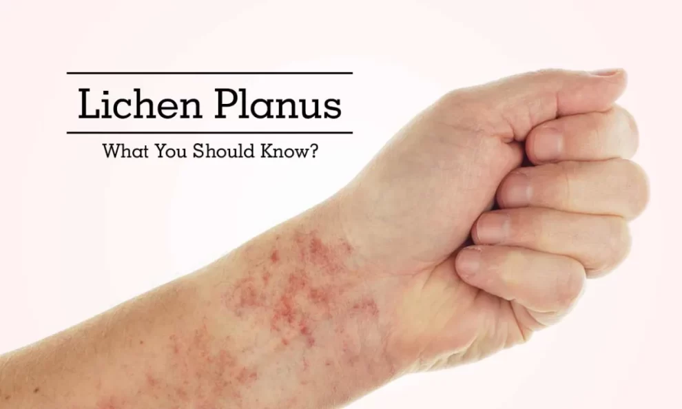 lichen planus