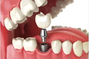Dental Implant Cost