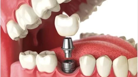 Dental Implant Cost