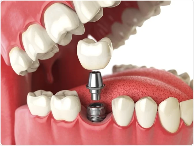 Dental Implant Cost