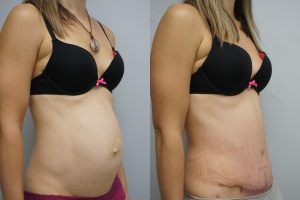 Lip abdominoplasty in Dubai