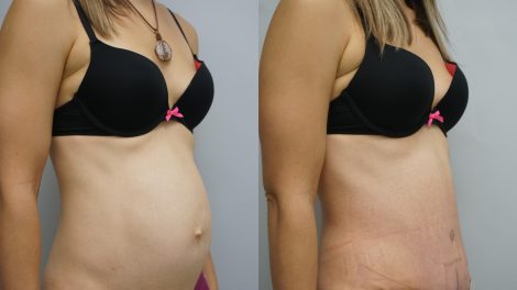 Lip abdominoplasty in Dubai