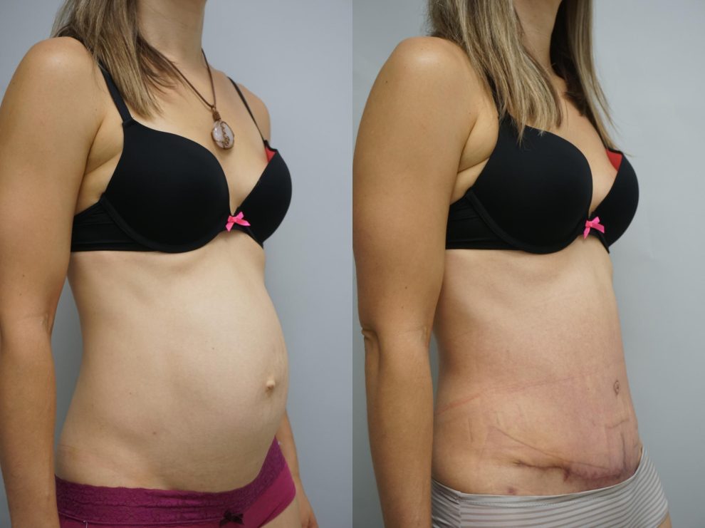 Lip abdominoplasty in Dubai