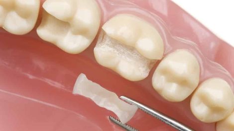 tooth fillings near me