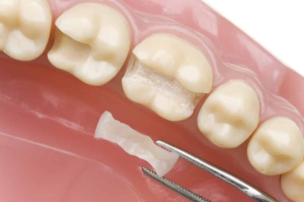 tooth fillings near me