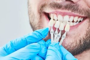 Veneers Surrey