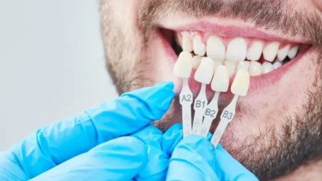 Veneers Surrey