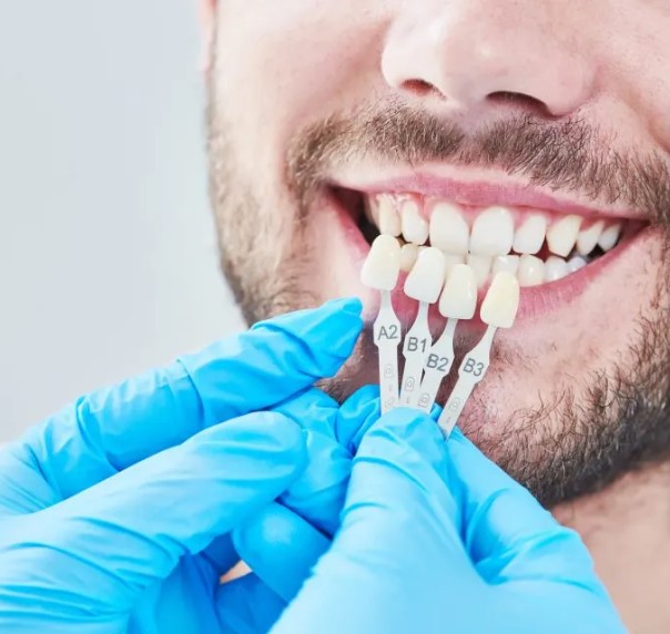 Veneers Surrey