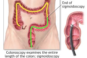 flexible sigmoidoscopy