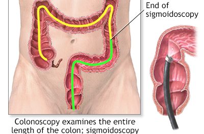 flexible sigmoidoscopy