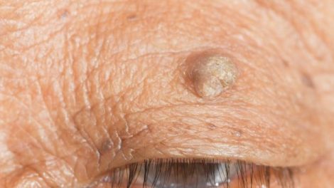skin tag on eyelid