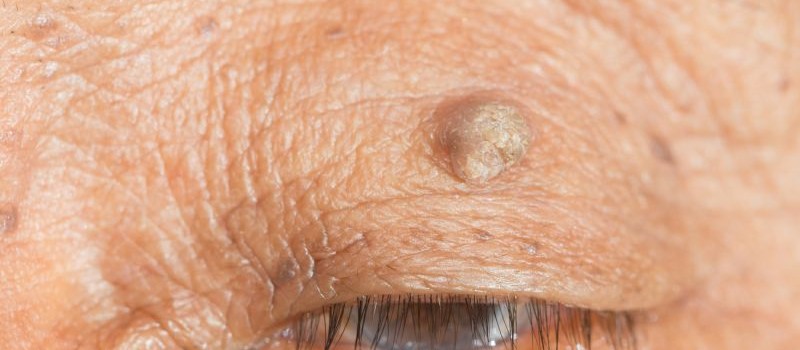 skin tag on eyelid