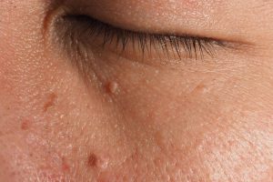 skin tags removal london treatment